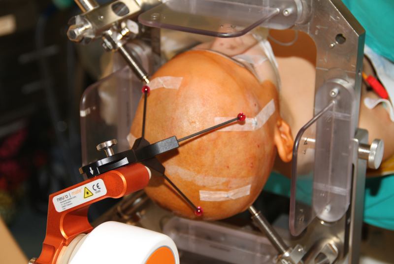 Roboti, kteří udělají přesnou díru do hlavy, zachraňují životy